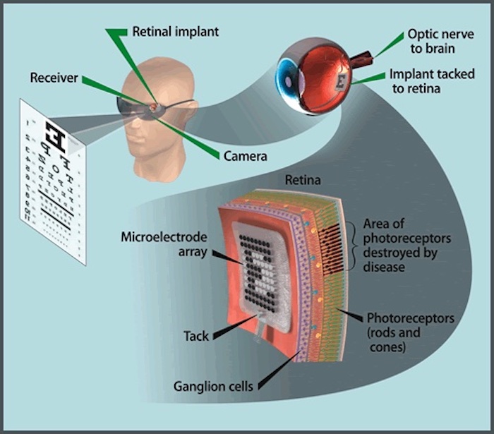 A high-level diagram of how a retina implant works.